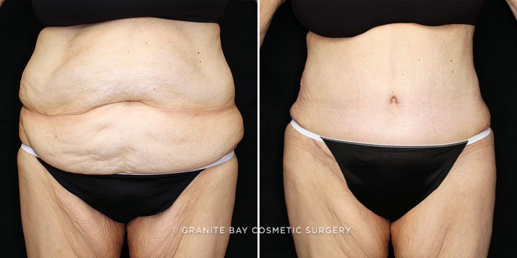 Liposuction Abdomen and Flanks Case 7001 - The Plastic Surgery Group