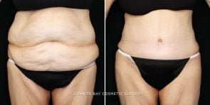 tummy-tuck-posterior-flank-liposuction-19871a-gbc