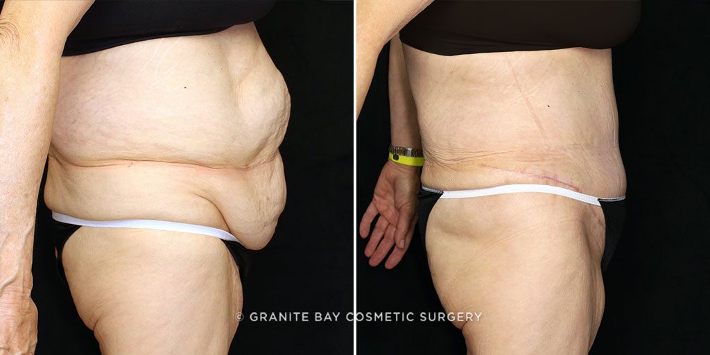 tummy-tuck-posterior-flank-liposuction-19871c-gbc