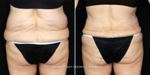 tummy-tuck-posterior-flank-liposuction-19871d-gbc