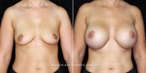 breast-augmentation-19546a-clark