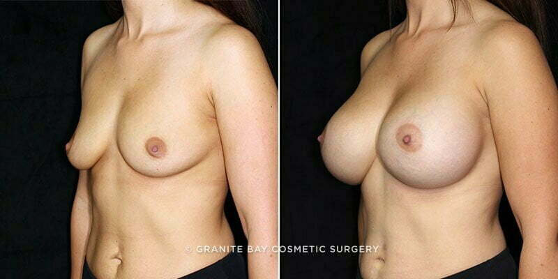 breast-augmentation-19546b-clark