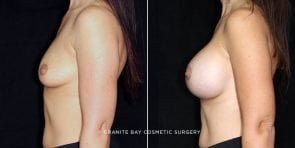 breast-augmentation-19546c-clark