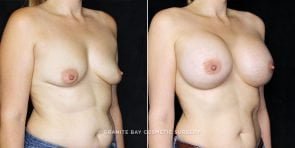 breast-augmentation-20557b-clark