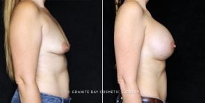 breast-augmentation-20557c-clark