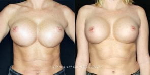 breast-revision-10593a-clark