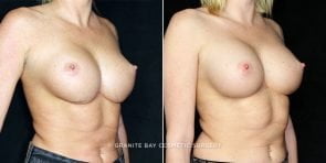 breast-revision-10593b-clark