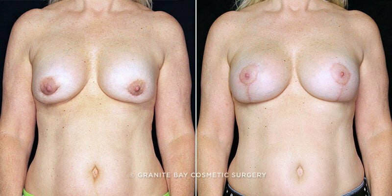 breast-revision-lift-19876a-clark