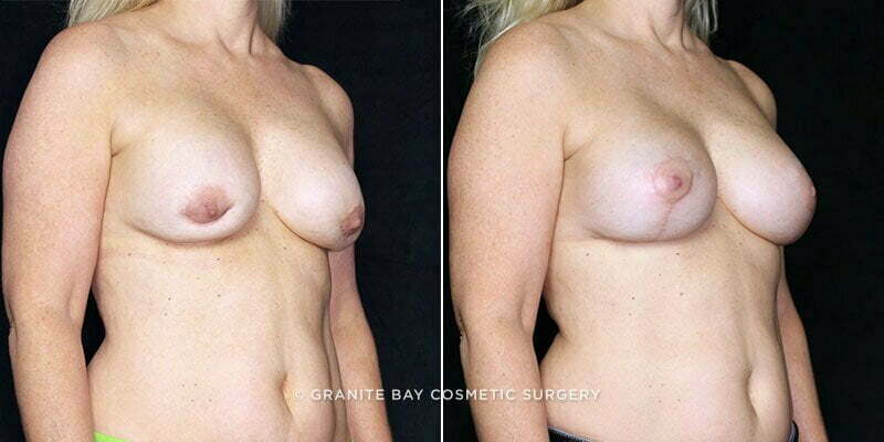 breast-revision-lift-19876b-clark