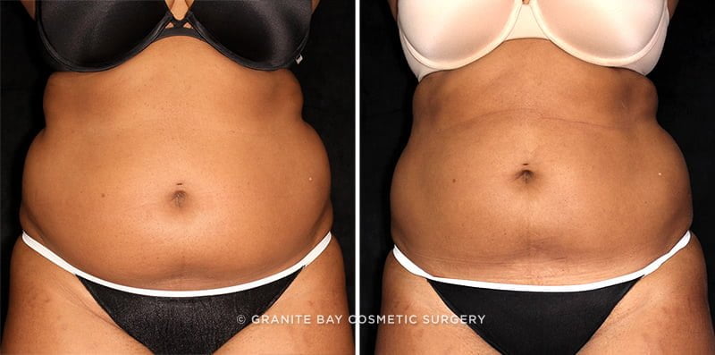 CoolSculpting