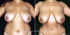 liposuction-axillary-03a-clark