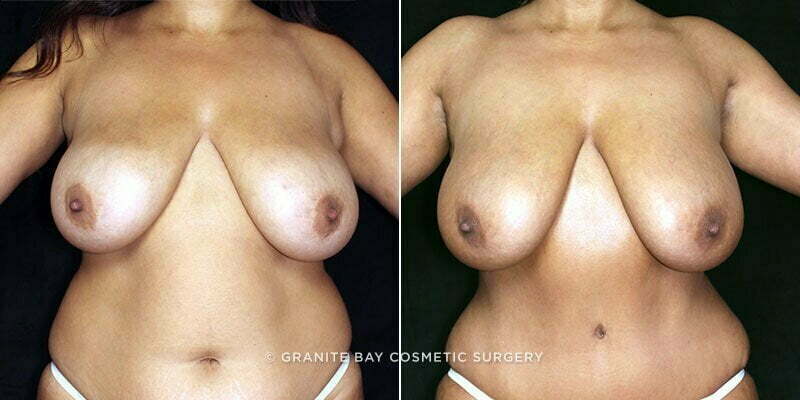 Liposuction of Axillary Breast Tissue
