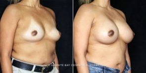 breast-augmentation-19901b-gbc
