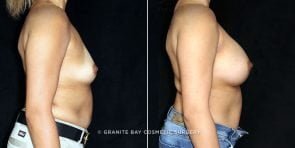 breast-augmentation-19901c-gbc