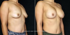 breast-augmentation-19967b-gbc