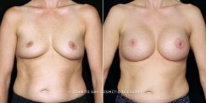 breast-augmentation-20417a-gbc