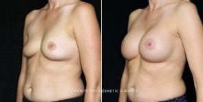 breast-augmentation-20417b-gbc