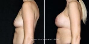 breast-augmentation-20417c-gbc