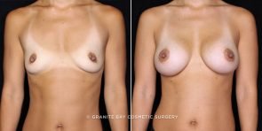 breast-augmentation-20560a-gbc