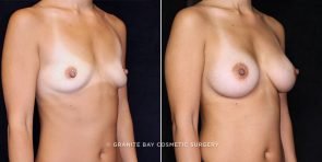 breast-augmentation-20560b-gbc