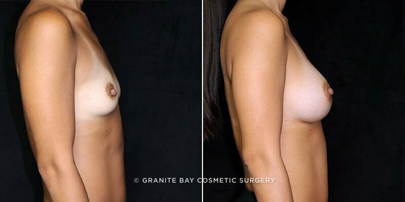 breast-augmentation-20560c-gbc