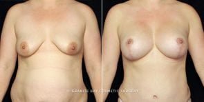 breast-lift-augmentation-19585a-gbc