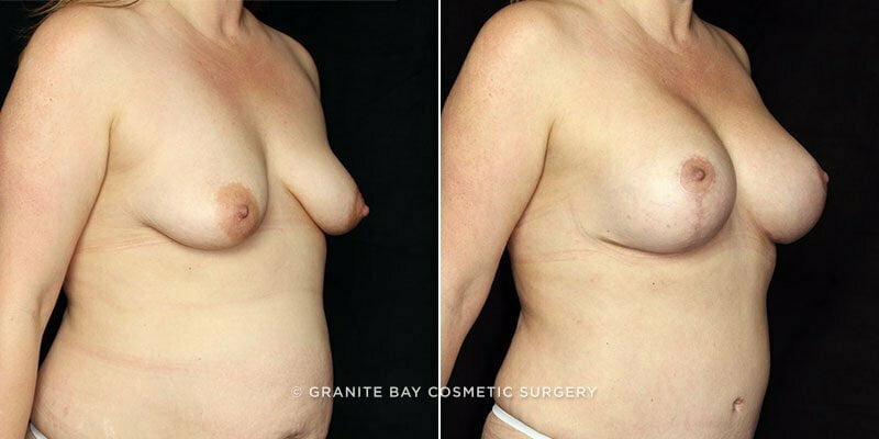 breast-lift-augmentation-19585b-gbc