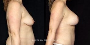 breast-lift-augmentation-19585c-gbc