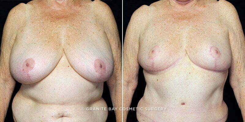 breast-reduction-20426a-gbc