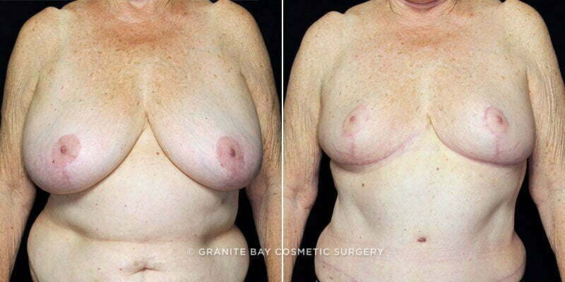Breast Reduction