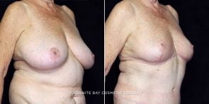 breast-reduction-20426b-gbc