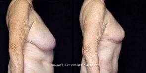 breast-reduction-20426c-gbc