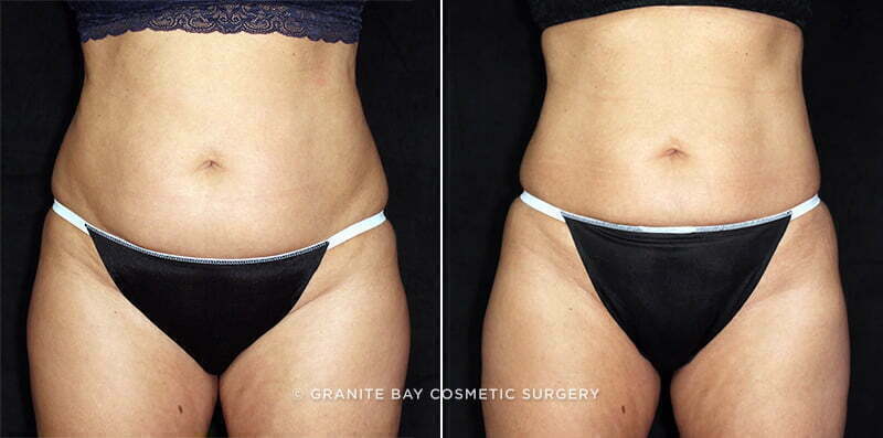 CoolSculpting