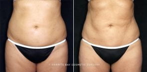 coolsculpting-abdomen-flanks-20443a-gbc-watermarked