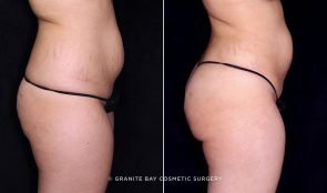 brazilian-butt-lift-liposuction-19596c-gbc