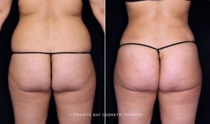 brazilian-butt-lift-liposuction-19596d-gbc