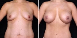 breast-augmentation-19411a-gbc