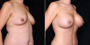 breast-augmentation-19411b-gbc