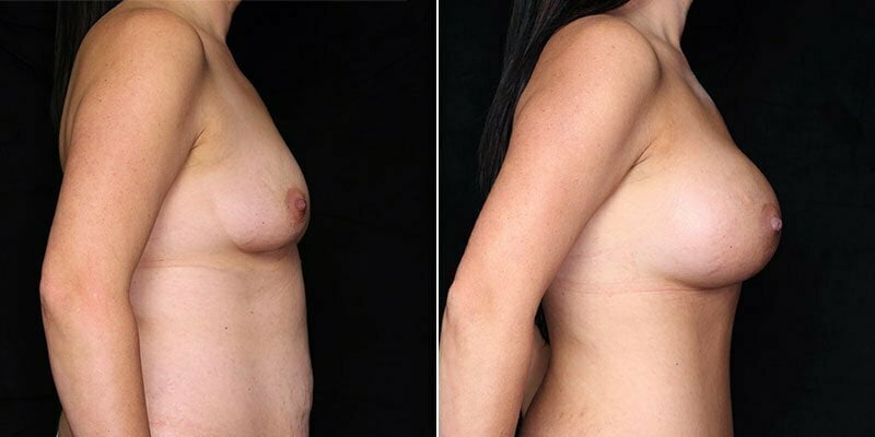 breast-augmentation-19411c-gbc