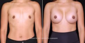 breast-augmentation-19877a-gbc