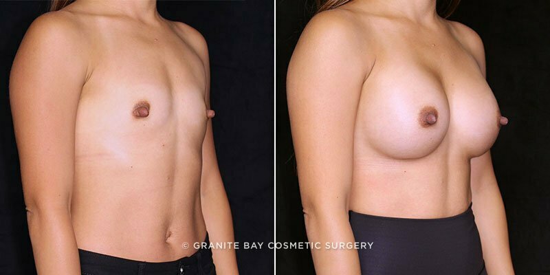 breast-augmentation-19877b-gbc