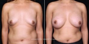 breast-augmentation-20084a-gbc
