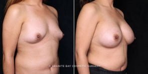 breast-augmentation-20084b-gbc