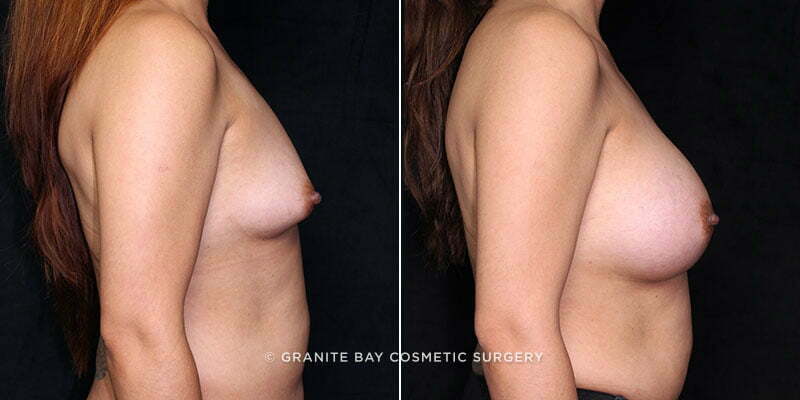 breast-augmentation-20084c-gbc
