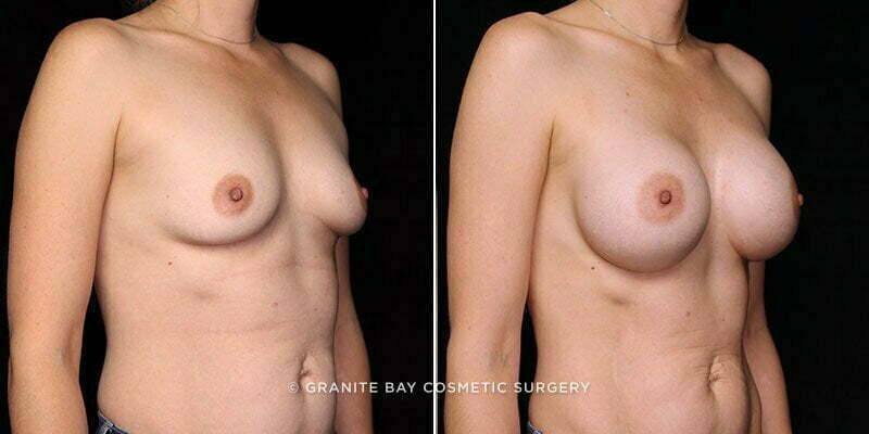 breast-augmentation-21071b-gbc