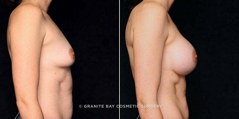 breast-augmentation-21071c-gbc