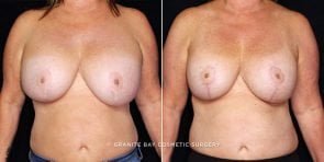 breast-implant-exchange-lift-20920-3a-gbc