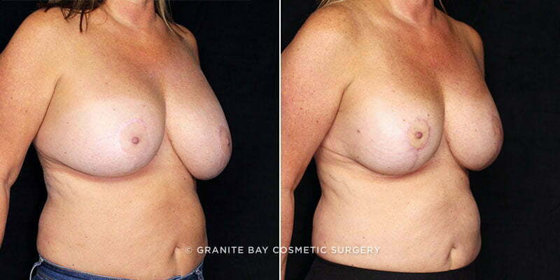 breast-implant-exchange-lift-20920-3b-gbc