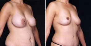 breast-implant-removal-19938b-gbc