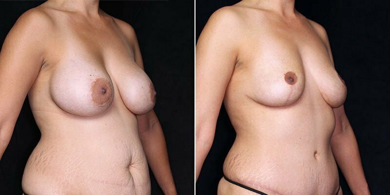 breast-implant-removal-19938b-gbc